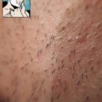 Grand Bazaar and Smart Skin Pseudofolliculitis Barbae (Razor Bumps)