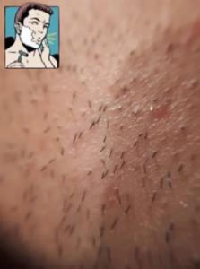 Grand Bazaar and Smart Skin Pseudofolliculitis Barbae (Razor Bumps)